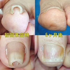 巻き爪補正